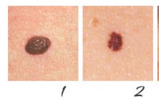 Первые признаки рака кожи